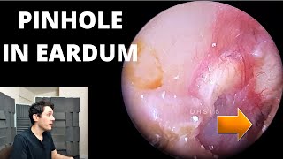 Pinhole Eardrum Perforation With White Fungal Growth In Canal [upl. by Pfister670]