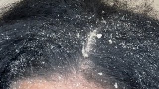 Dandruff Scratching Massive Buildup amp Flakes Popping [upl. by Rialb]