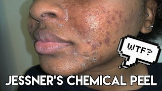 CHEMICAL PEEL  PROCEDURE  PEELING  BEFORE amp AFTER  JESSNER CHEMICAL PEEL  KENSTHETIC [upl. by Ivets]