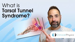 Tarsal Tunnel Syndrome  Expert Physio Guide [upl. by Skcirdnek416]