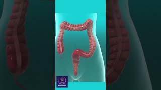 Colectomy Removal of Colon shorts education [upl. by Kira]