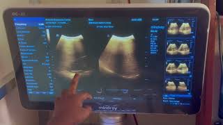 A case of Right sided Hydronephrosis with Right Nephrolithiasis scanning in Ultrasonography [upl. by Enaffit]