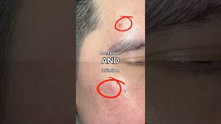 Best spot treatment drbelmeur spottreatment skincare acne acneproneskin acneskincare kbeauty [upl. by Pirri406]