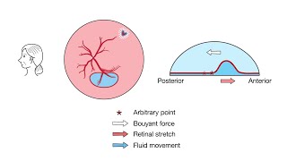 Views of the Mechanism of Retinal Displacement Following Pars Plana Vitrectomy [upl. by Niehaus]