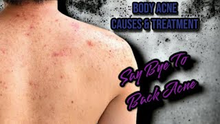 How To Remove Body Acne Fast What Causes Body Acne Back Acne Treatment [upl. by Leonid127]