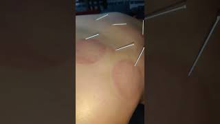 Dry needling acupuncture [upl. by Inele]