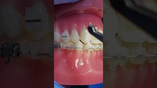 Orthodontics and Braces Improving Teeth Alignment [upl. by Oinolopa50]