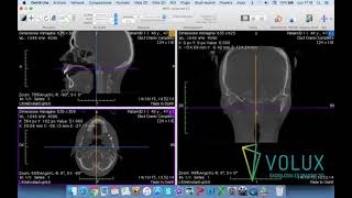 Volux  Tutorial OsiriX Lite parte 2 di 2 [upl. by Lednahc]