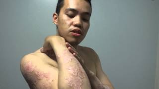 Psoriasis  Consentyx Journey day 1 Biological treatment [upl. by Irianat]