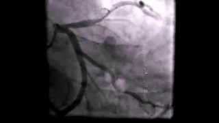 Coronary artery thrombus [upl. by Chap326]