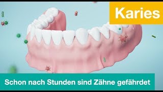 Karies  so schnell sind Zähne in Gefahr [upl. by Lyris]