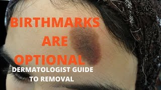 How to remove birthmarks [upl. by Sirmons]