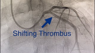 Thrombus Shifts to LCX Acute Anterior MI Cardiogenic Shock Ostial LAD Occlusion How To Treat [upl. by Garrity56]