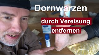 Fuß Warzen selber entfernen durch vereisen Warze Dornwarzen Vereisung  Fußwarzen Entfernung [upl. by Eeuqram]