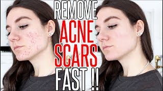 How To Get Rid Of ACNE SCARS OVERNIGHT [upl. by Enilauqcaj]