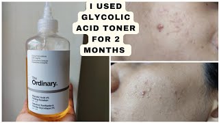 I used The Ordinary Glycolic Acid Toner for 2 months [upl. by Conner]