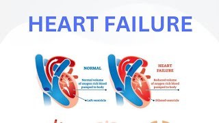 Heart failure  Left ventricle  Heart dysfunction Ejection fraction  sudden cardiac death [upl. by Fara]