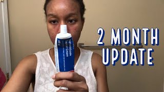 2 month Update Review of Metronidazole Cream for my Perioral Dermatitis and Acne [upl. by Magnien494]