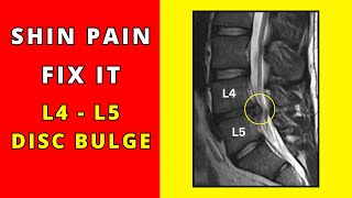 How to fix Shin pain due to lumbar L4  L5 disc bulges [upl. by Arabella]