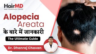 Ultimate Alopecia Areata Guide  Alopecia Areata के बारे में जानकारी  HairMD Pune [upl. by Omari]