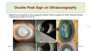 Perioperative Assessment of Intumescent Cataract How to Prevent Argentinian Flag Sign [upl. by Emarej]