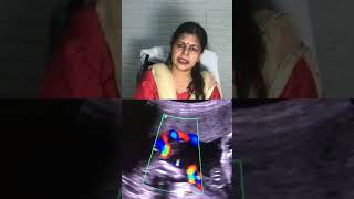 Color Doppler ultrasound in pregnancy  shortvideoDrhome [upl. by Vanna]