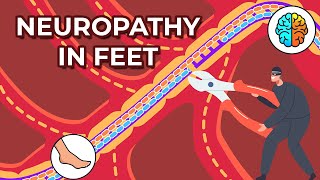 Dealing with Neuropathy in Feet Causes Symptoms and Treatments [upl. by Darline]