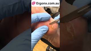 Callus removed with scalpel from a patients foot by podiatrist ergonxcomau [upl. by Nivlem21]