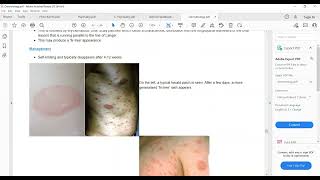 Plab 1 Lectures Dermatology Part 11 Acnae Rosacea Pityriasis Rosea Scabies [upl. by Manup623]