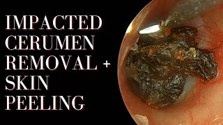 Impacted Cerumen Removal  Skin Peeling [upl. by Asilanna]