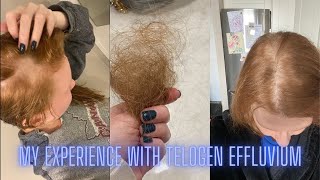 My Experience with Telogen Effluvium [upl. by Neehahs7]