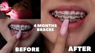 4 MONTHS BRACES UPDATE HUGE CHANGES [upl. by Ahsiuqal]