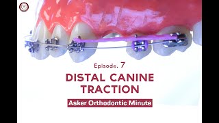 Distal Canine Traction Asker Orthodontic Minute Episode 7 [upl. by Mar925]