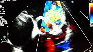 Echocardiogram  Ventricular septal defect  Supracristal subarterial doubly committed [upl. by Legra623]