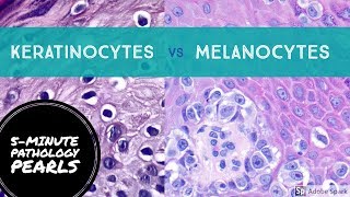 Melanocytes vs Keratinocytes Made Easy 5Minute Pathology Pearls [upl. by Sikorski45]