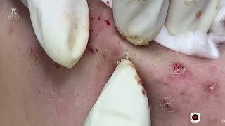 Big Cystic Acne Blackheads Extraction Blackheads amp Milia Whiteheads Removal Pimple Popping [upl. by Romine561]