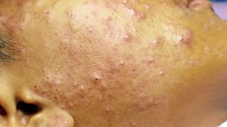 Extraction boutons et acné kystique cystic acne sur le visage [upl. by Jordanson997]