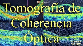 Tomografía de Coherencia Óptica en la Patología Ocular [upl. by Christal]