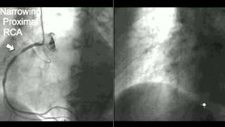 Coronary CT Angiography Cath [upl. by Rovelli154]