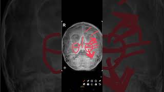 ENT Ospe Xray of Paranasal sinuses part01ENTDrTayyibaarshad [upl. by Yenattirb]