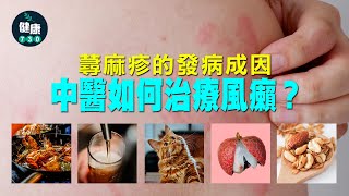 醫SICK醫識｜蕁麻疹的發病成因 中醫如何治療風癩？ [upl. by Mead]