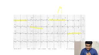 MASTERING ECGLESSON15 RIGHT BUNDLE BRANCH BLOCK RBBB [upl. by Newmann368]