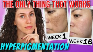 The ONLY Ingredients That Stop Hyperpigmentation And Reverse It [upl. by Ernesto531]