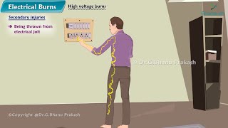 4 Burns Part4  Electrical Burns and Post Burn Neck Contractures [upl. by Giglio]