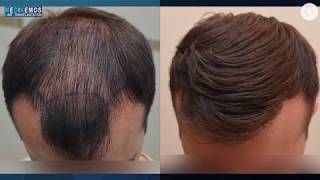 FUE 3027 Fu´s Dr Lupanzula MeDiKemos ENG hairtransplant [upl. by Oicnecserc60]