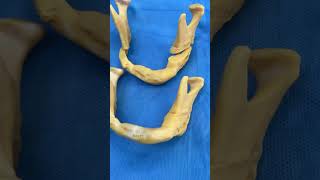 Lower Jaw Reconstruction with Custom Made Patient Specific Titanium Implants [upl. by Ermentrude891]