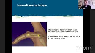 Intramedullary Compression Fixation of Metacarpal and Phalangeal Fractures [upl. by Antonella938]