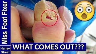 How to Treat Paronychia by Miss Foot Fixer Marion Yau [upl. by Anaeco714]