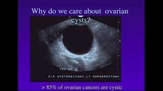 Screening of Ovarian Cancer [upl. by Enelak377]