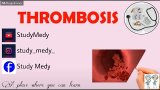 Thrombosis PathologyDefinitionCauses of thrombosisVirchows triadPathogenesisBlood clot [upl. by Leonhard765]